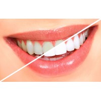 Teeth Whitening - Bleaching 